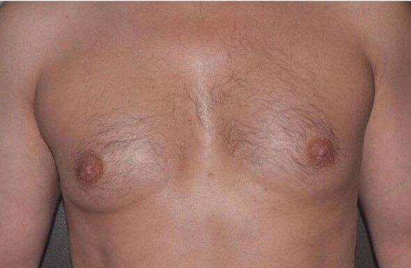 Gynecomastia Surgery before at Dr. Roman Rayham, MD in Brooklyn, NY
