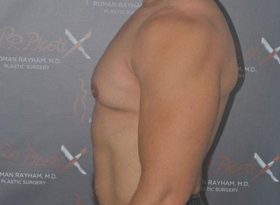 Gynecomastia Surgery before at Dr. Roman Rayham, MD in Brooklyn, NY