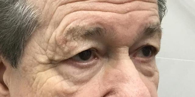 Blepharoplasty before at Dr. Roman Rayham, MD in Brooklyn, NY