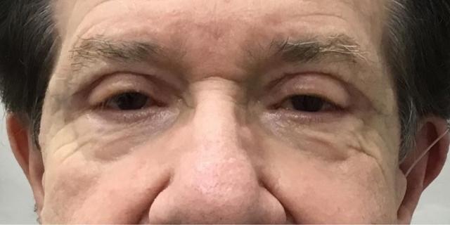 Blepharoplasty after at Dr. Roman Rayham, MD in Brooklyn, NY