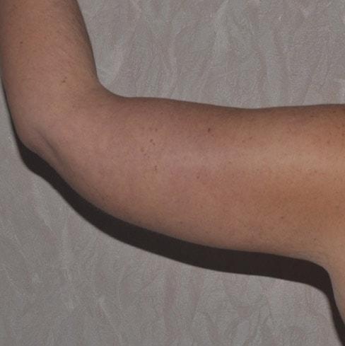 Arm Lift after at Dr. Roman Rayham, MD in Brooklyn, NY