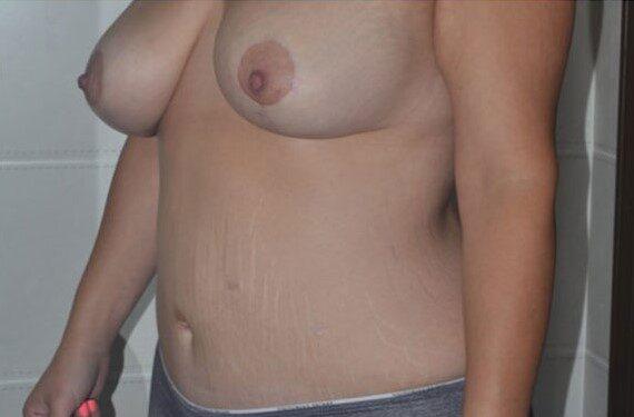 Mini Tummy Tuck after at Dr. Roman Rayham, MD in Brooklyn, NY