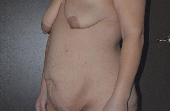 Mini Tummy Tuck before at Dr. Roman Rayham, MD in Brooklyn, NY