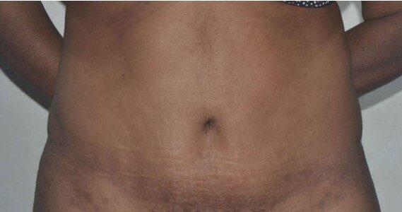 Mini Tummy Tuck after at Dr. Roman Rayham, MD in Brooklyn, NY