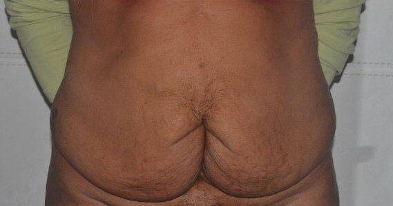 Mini Tummy Tuck before at Dr. Roman Rayham, MD in Brooklyn, NY