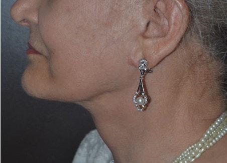 Deep Plane Facelift after at Dr. Roman Rayham, MD in Brooklyn, NY