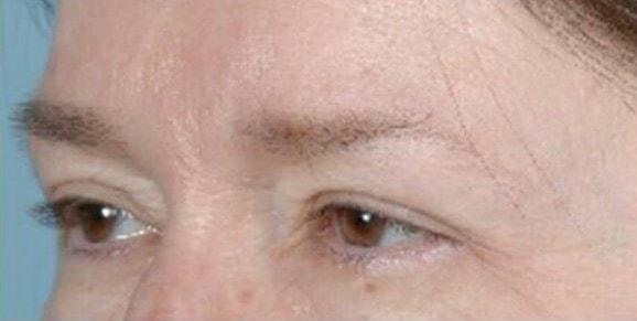 Brow Lift after at Dr. Roman Rayham, MD in Brooklyn, NY