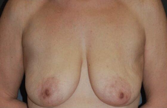 Breast Lift before at Dr. Roman Rayham, MD in Brooklyn, NY