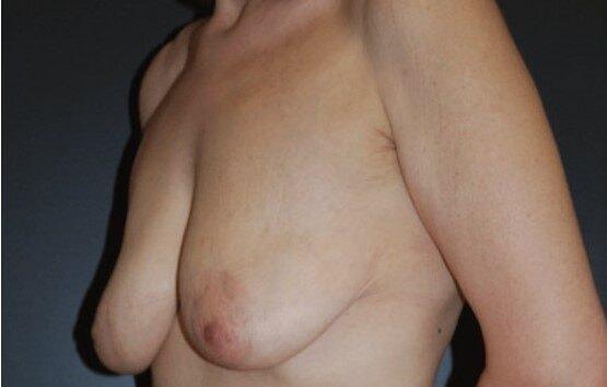 Breast Lift before at Dr. Roman Rayham, MD in Brooklyn, NY