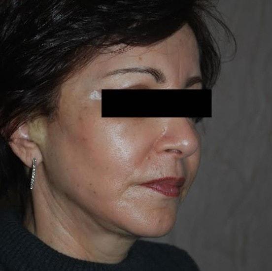 Deep Plane Facelift after at Dr. Roman Rayham, MD in Brooklyn, NY