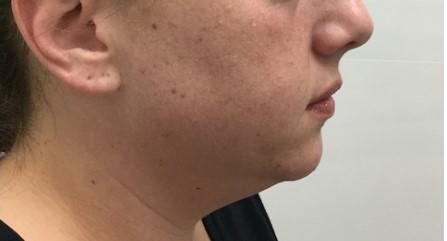 Arm Lift result at Dr. Roman Rayham, MD in Brooklyn, NY