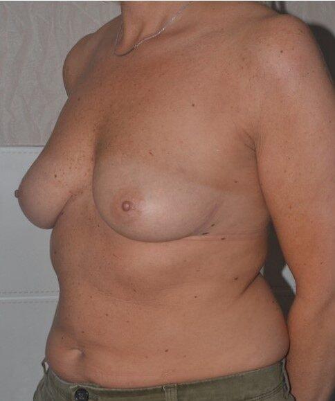 Breast Lift before at Dr. Roman Rayham, MD in Brooklyn, NY