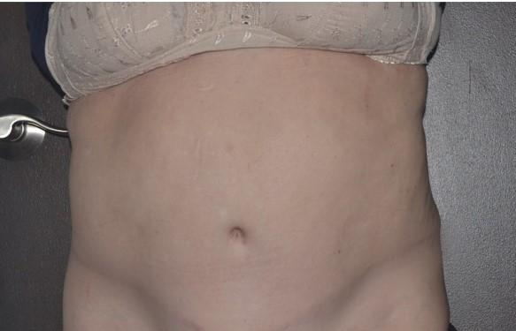 Tummy Tuck after at Dr. Roman Rayham, MD in Brooklyn, NY