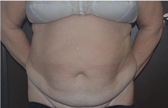 Tummy Tuck before at Dr. Roman Rayham, MD in Brooklyn, NY