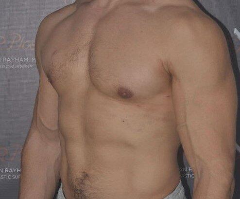 Gynecomastia Surgery after at Dr. Roman Rayham, MD in Brooklyn, NY