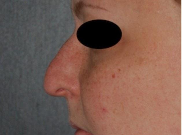 Rhinoplasty before at Dr. Roman Rayham, MD in Brooklyn, NY