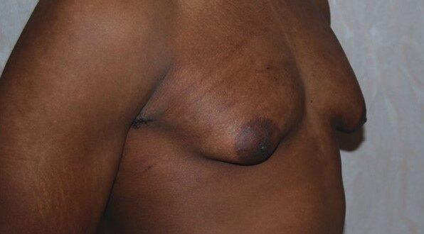 Gynecomastia Surgery before at Dr. Roman Rayham, MD in Brooklyn, NY