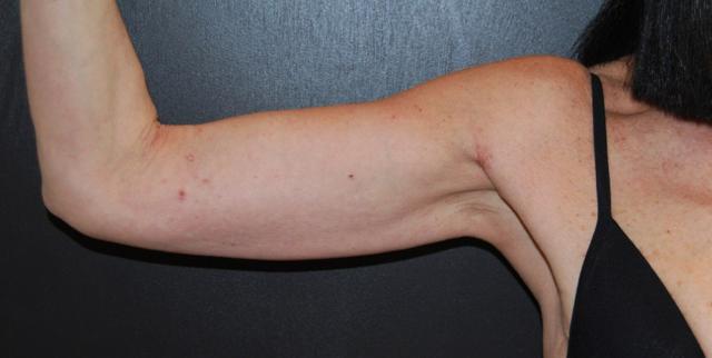 Arm Lift result at Dr. Roman Rayham, MD in Brooklyn, NY