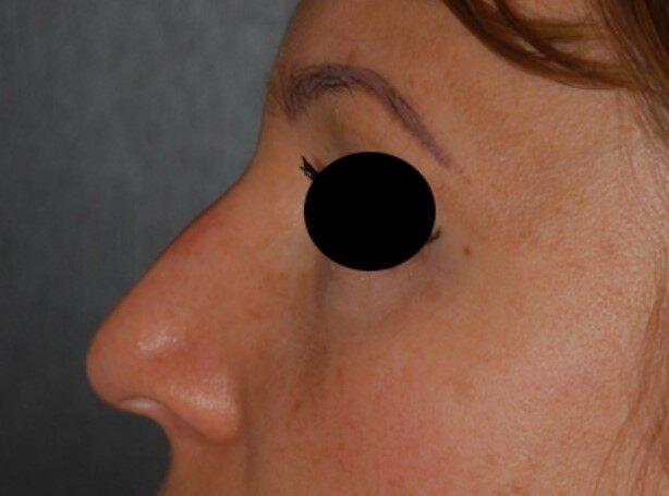 Rhinoplasty before at Dr. Roman Rayham, MD in Brooklyn, NY