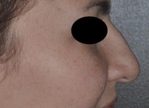Rhinoplasty before at Dr. Roman Rayham, MD in Brooklyn, NY