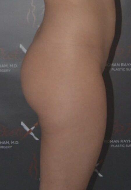 Brazilian Butt Lift before at Dr. Roman Rayham, MD in Brooklyn, NY