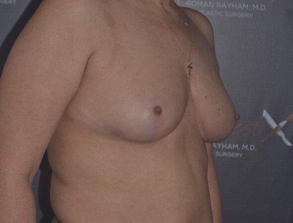 Breast Reduction after at Dr. Roman Rayham, MD in Brooklyn, NY