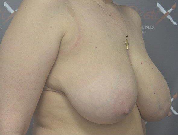 Breast Reduction before at Dr. Roman Rayham, MD in Brooklyn, NY