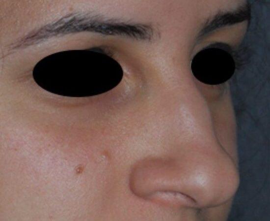 Rhinoplasty before at Dr. Roman Rayham, MD in Brooklyn, NY