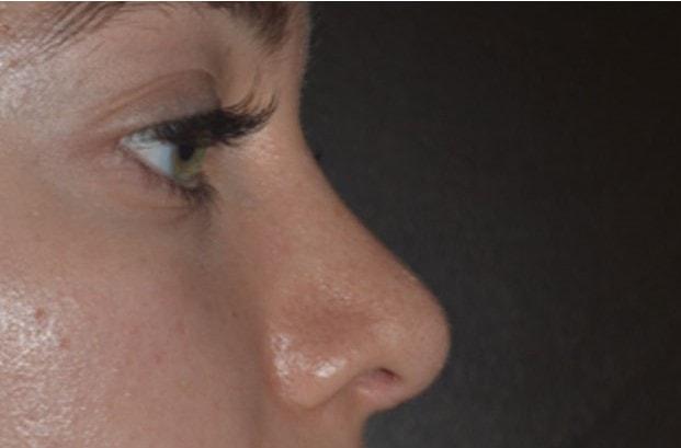 Rhinoplasty after at Dr. Roman Rayham, MD in Brooklyn, NY