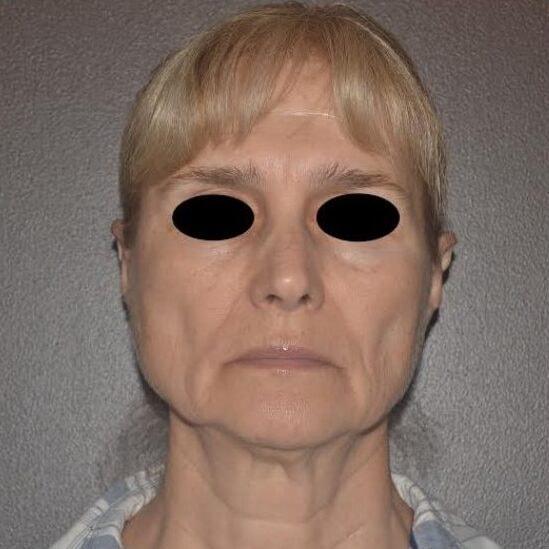 Deep Plane Facelift before at Dr. Roman Rayham, MD in Brooklyn, NY