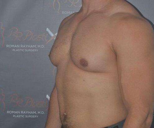 Gynecomastia Surgery before at Dr. Roman Rayham, MD in Brooklyn, NY