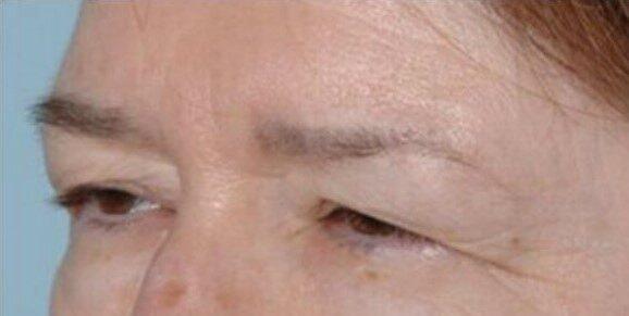 Brow Lift before at Dr. Roman Rayham, MD in Brooklyn, NY