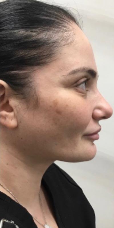 Dr. Roman Rayham, MD arm lift after — Brooklyn, NY