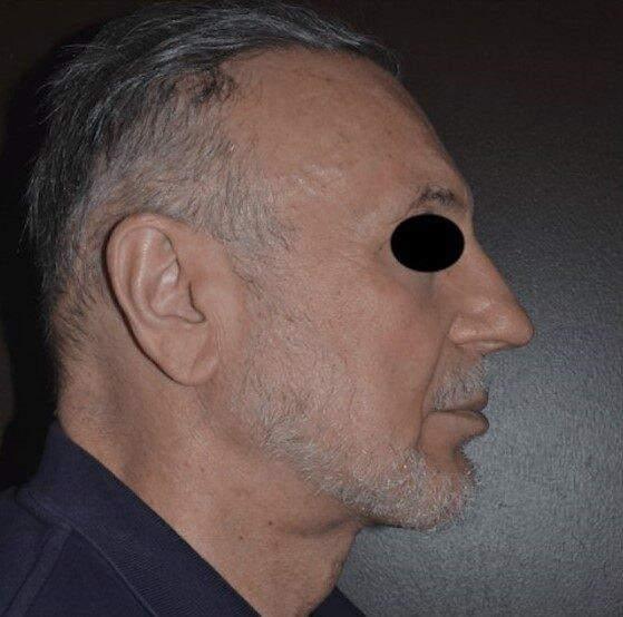 Deep Plane Facelift after at Dr. Roman Rayham, MD in Brooklyn, NY