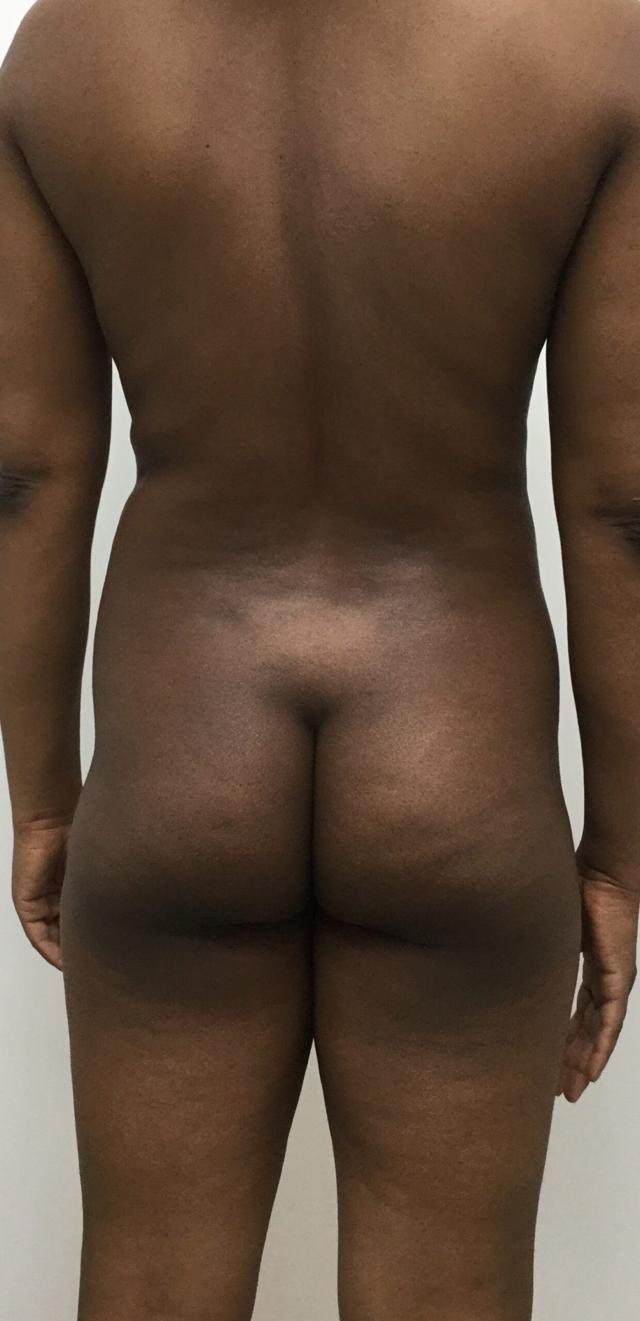 Brazilian Butt Lift before at Dr. Roman Rayham, MD in Brooklyn, NY