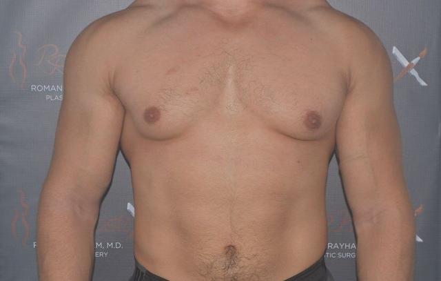 Gynecomastia Surgery before at Dr. Roman Rayham, MD in Brooklyn, NY