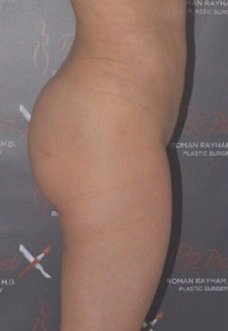 Brazilian Butt Lift after at Dr. Roman Rayham, MD in Brooklyn, NY