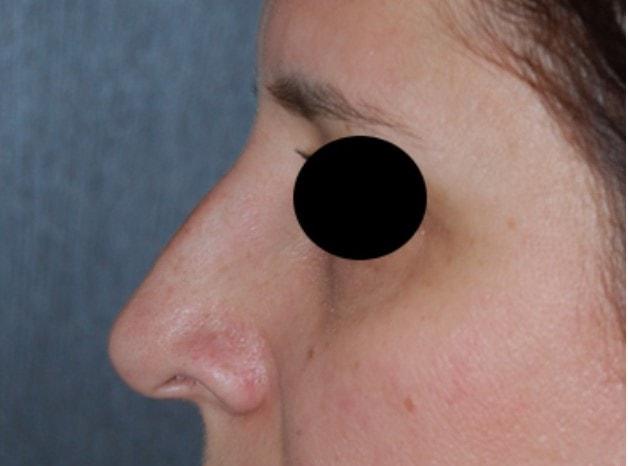 Rhinoplasty before at Dr. Roman Rayham, MD in Brooklyn, NY
