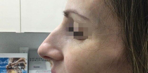 Rhinoplasty before at Dr. Roman Rayham, MD in Brooklyn, NY