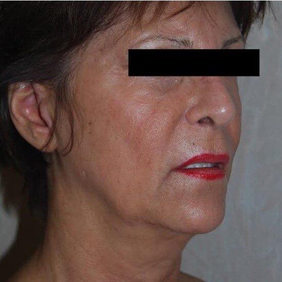 Deep Plane Facelift before at Dr. Roman Rayham, MD in Brooklyn, NY