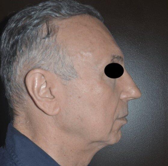 Deep Plane Facelift before at Dr. Roman Rayham, MD in Brooklyn, NY