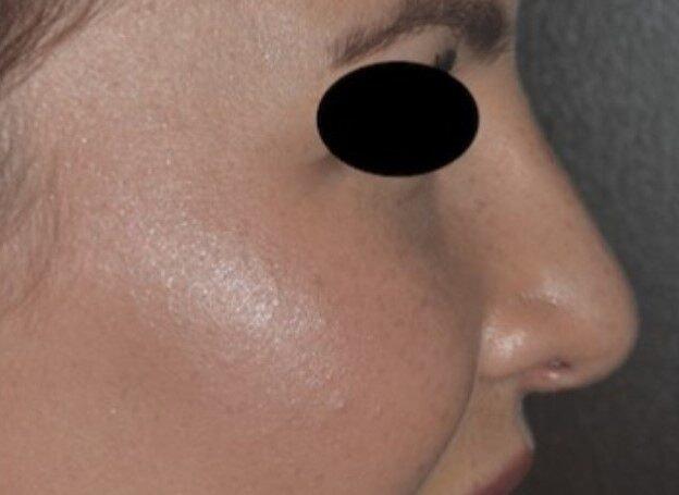 Rhinoplasty after at Dr. Roman Rayham, MD in Brooklyn, NY