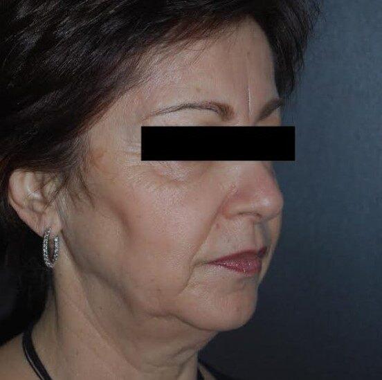 Deep Plane Facelift before at Dr. Roman Rayham, MD in Brooklyn, NY