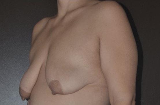 Breast Lift before at Dr. Roman Rayham, MD in Brooklyn, NY