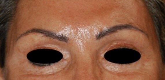 Brow Lift after at Dr. Roman Rayham, MD in Brooklyn, NY
