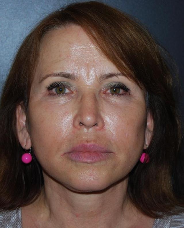 Deep Plane Facelift after at Dr. Roman Rayham, MD in Brooklyn, NY