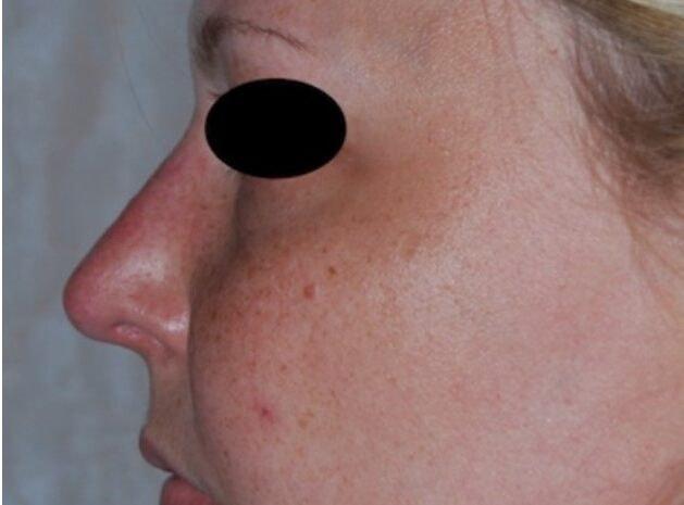Rhinoplasty after at Dr. Roman Rayham, MD in Brooklyn, NY