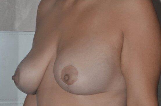 Breast Lift after at Dr. Roman Rayham, MD in Brooklyn, NY