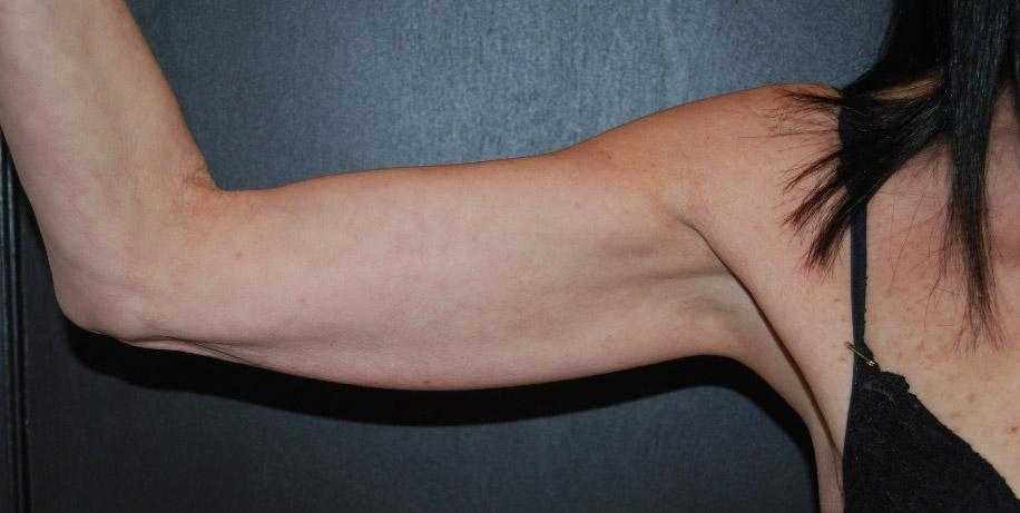Dr. Roman Rayham, MD arm lift result — Brooklyn, NY