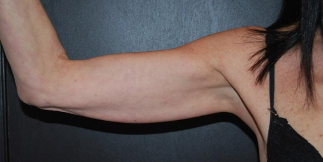 Arm Lift result at Dr. Roman Rayham, MD in Brooklyn, NY